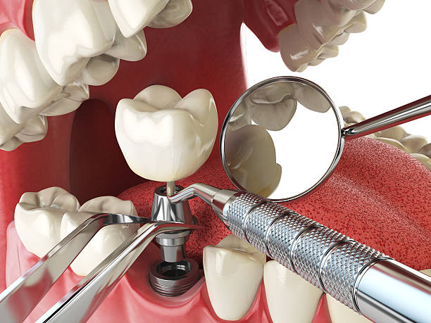 Best Emergency Root Canal Treatment in Massac, KY